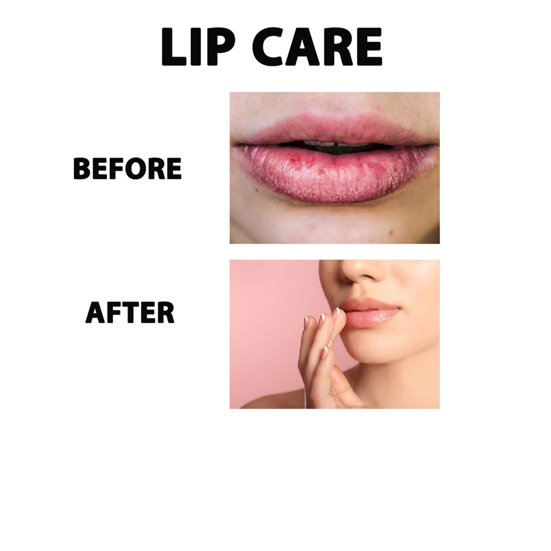 Chapped Lips Treatment | Cracked Lips | Lip Care