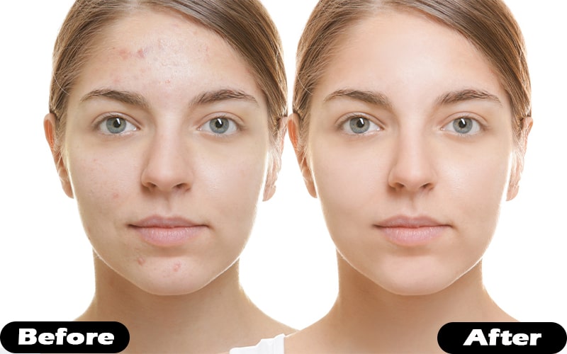 How to Minimize Pores in Just 3 days