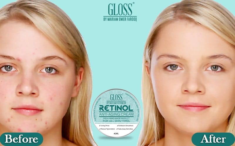 Get Rid of Aging, Wrinkles & Fine Lines | Natural Skin Glow Cream