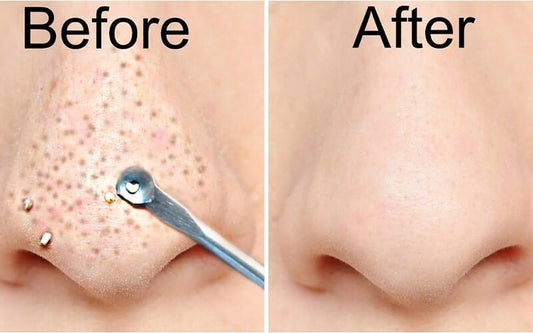 Wanna Remove Black Heads in Just 7 Days | Get Natural Glow